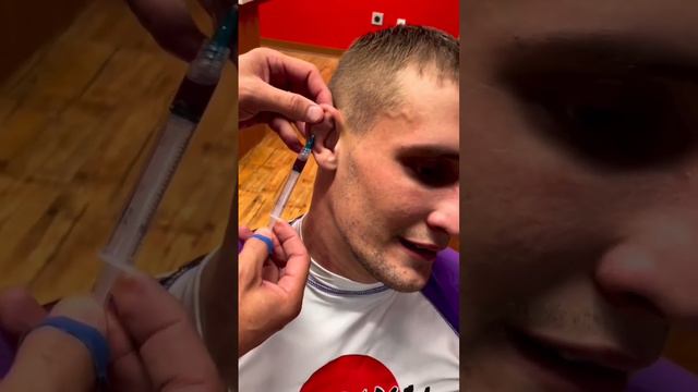 Cauliflower ear draining Pt. 2 👂🏼 💉