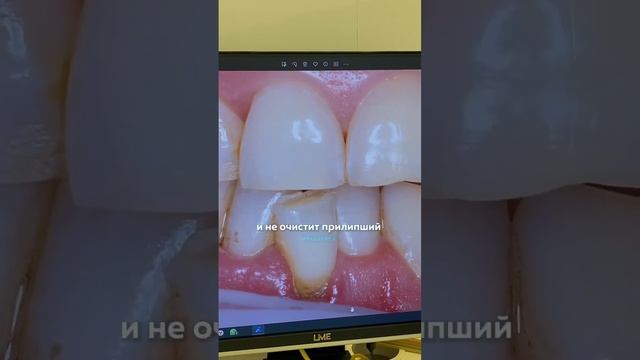 Зубная нить ≠ ирригатор. Было интересно? Подпишись? смотреть онлайн