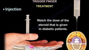 Trigger Finger & Trigger Thumb - Everything You Need To Know - Dr. Nabil Ebraheim