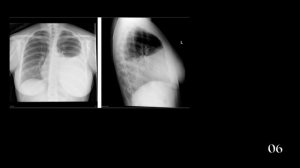 X Ray paru abnormal