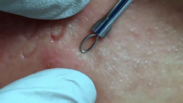 Удаление чёрных точек на лице. Лечение акне. Как убрать черные точки смотреть онлайн