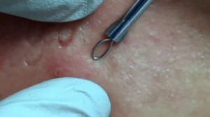 Удаление чёрных точек на лице. Лечение акне. Как убрать черные точки