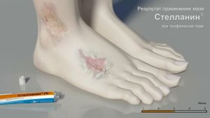 Результат применения мази СТЕЛЛАНИН при трофической язве