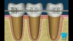 Смещение зубов и перестройка кости во время лечения брекетами