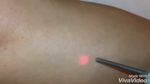 Лазерная эпиляция fotona смотреть онлайн