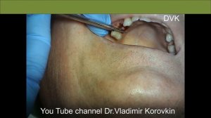 Состояние после имплантации 14.Снятие швов.#sutures