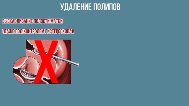Полипы эндометрия и цервикального канала