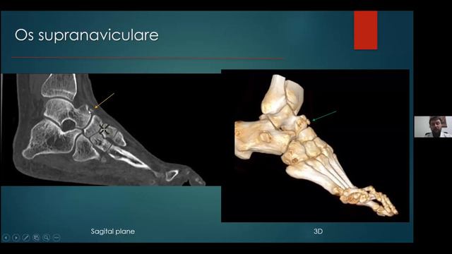 Вебінар - Діагностичні можливості КТ при патології стопи смотреть онлайн