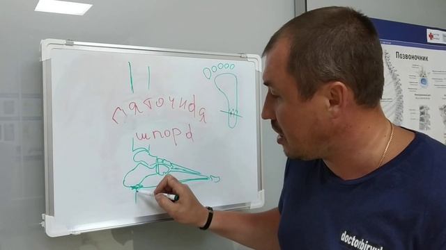 Пяточная шпора