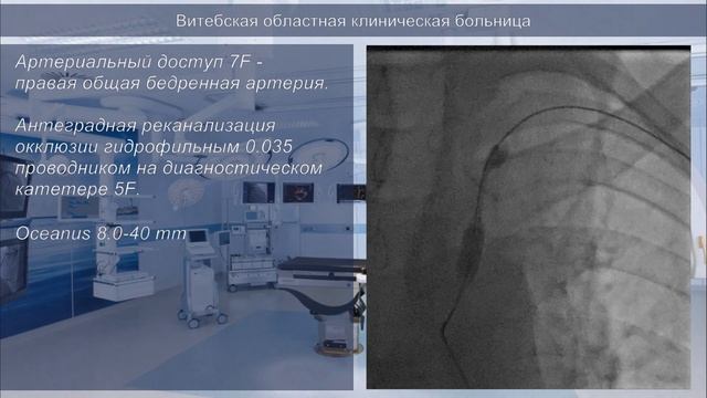 РЭВХ ВОКБ 015 подключичная артерия смотреть онлайн
