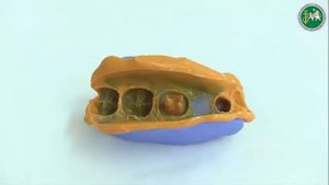 Изготовление литой культевой штифтовой вкладки непрямымкосвенным методом