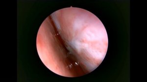 Rzayev R.M. Эндоскопическая септопластика.