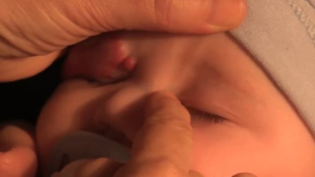 Массаж слезного мешка смотреть онлайн