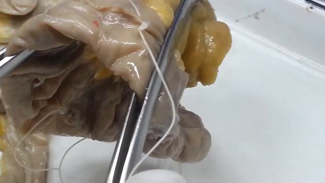 intestinal sutures- кишечные швы ( Ламбера , жели , альберта швы) ٌ смотреть онлайн