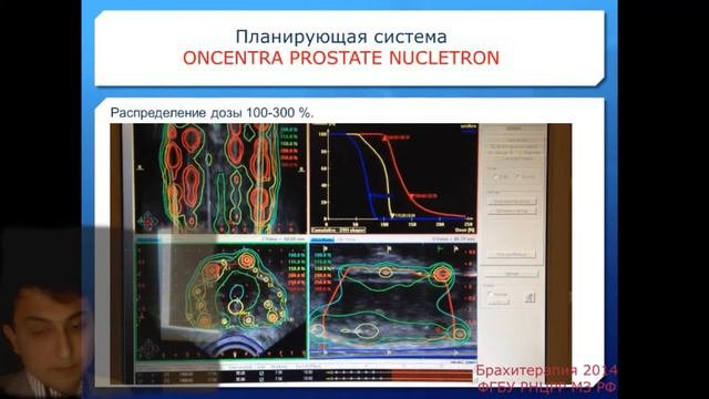 Высокомощностная брахитерапия рака предстательной железы - Ir-192 (ирридий)