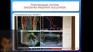 Высокомощностная брахитерапия рака предстательной железы - Ir-192 (ирридий)