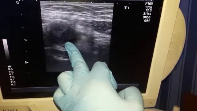 О аппендицит смотреть онлайн