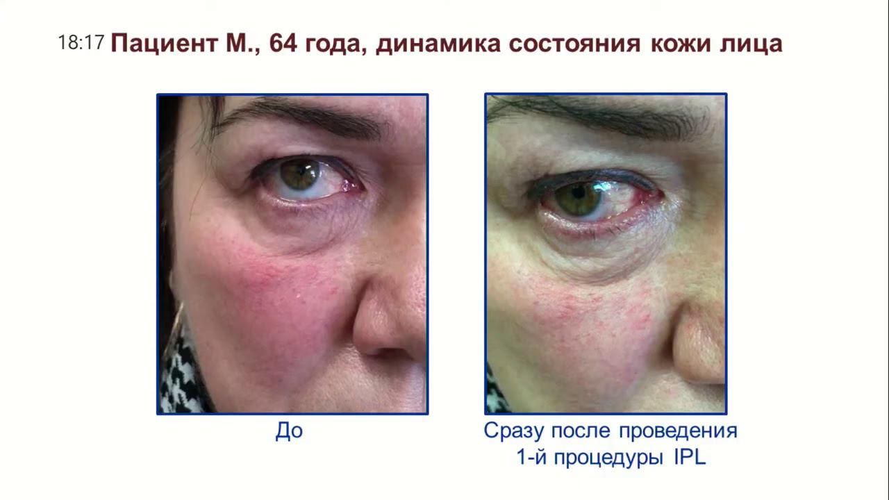 Опыт расширения показаний к IPL-терапии: офтальморозацеа, нитчатый кератит, рецидивирующие эрозии