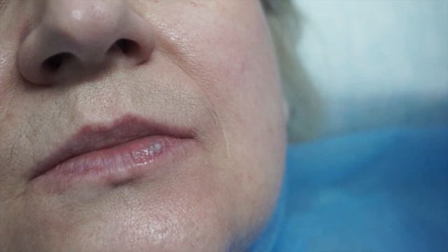 Как Удалить Ангиому На Губе Лазером смотреть онлайн