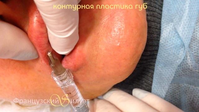Контурная пластика губ (Киев) смотреть онлайн
