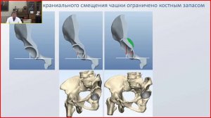 Тотальное эндопротезирование при диспластическом артрозе ТБС и высоком вывихе бедренной кости.