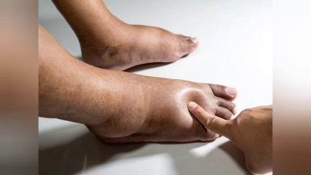 Как понять что ноги отекают из-за сердца? смотреть онлайн