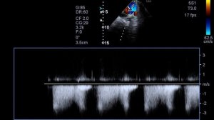 Коронарная фистула у ребенка