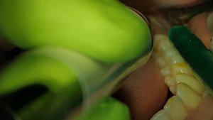 Удаление зуба "мудрости" с ультразвуком