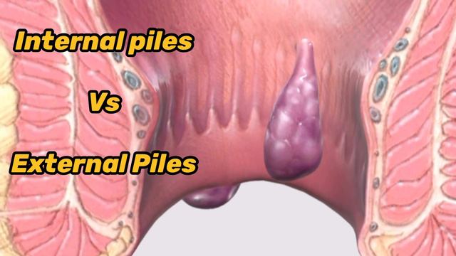 BAADI BAVASIR Vs Khooni Bawasir ? Which are different types of Piles & Haemorrhoids ? Piles meaning смотреть онлайн