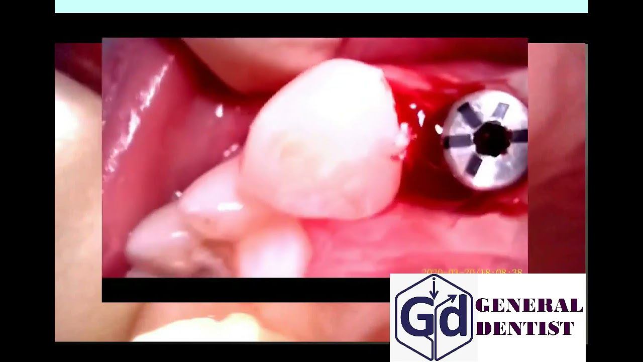 Insertion the gingiva former area 12 .