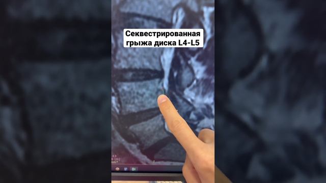 Секвестрированная грыжа L4-L5. #грыжадиска