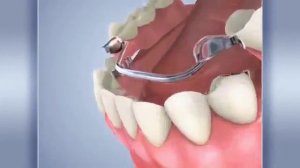 Бюгельный протез жевательного зуба