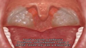 Причины появления гнойников в горле