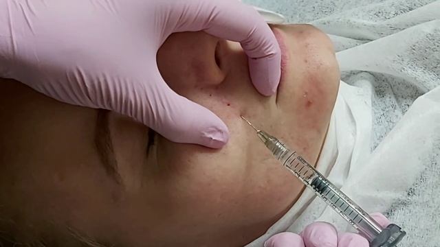 Заполнение носогубной складки филлером SURGIDERM 30xp