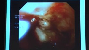 14 Короткевич А Г    Желудочное кровотечение   остановка с использованием перекиси водорода