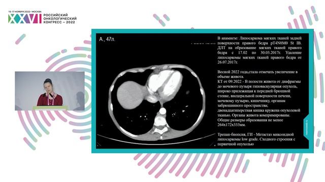 Современная концепция лечения забрюшинных неорганных сарком: проблемы и пути их решения