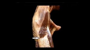 Напрягатель широкой фасции бедра Musculus tensor fasciae latae