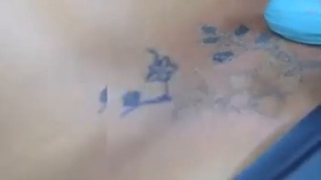 Удаление татуировки . Лазерная смотреть онлайн