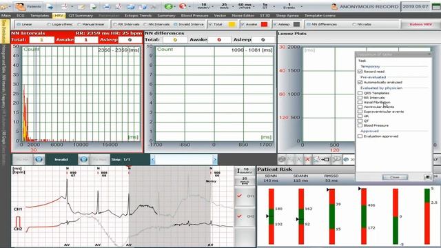 Labtech Holter Video 5 NN, RR validation, Atrial fibrillation detection смотреть онлайн