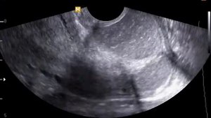 Крупные наботовы кисты шейки матки с воспалительным содержимым