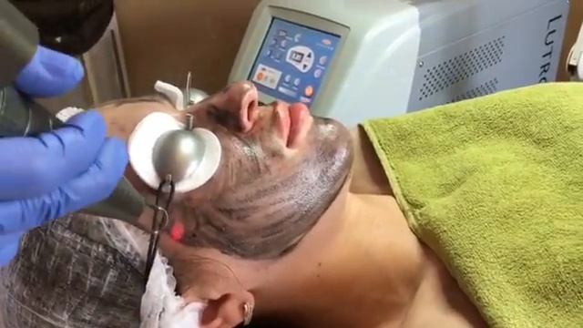 Лазерный карбоновый пилинг клиника Studio Smile смотреть онлайн