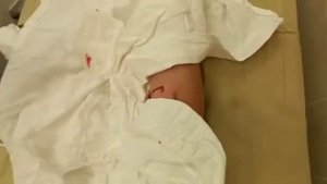 Удаление винта из Голени