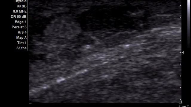 Образование в проекции семенного канатика 10 смотреть онлайн