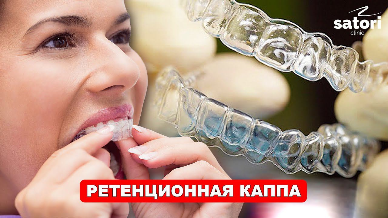 Ретенционная каппа