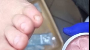 Мозоль между пальцами + разгрузка🦶🏻⚠️🆘