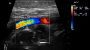 Образование в подколенной ямке