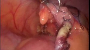 лапароскопическая аппендэктомия с погружением