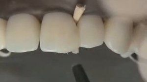 Препарирование по Блэку 4 класс