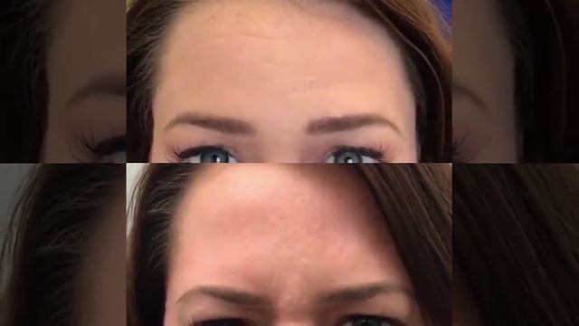 диспорт до и после смотреть онлайн