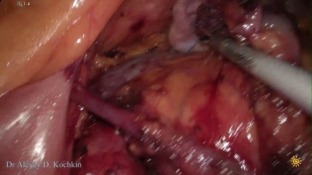 Transmesocolic Nephrectomy/RPLND/трансмезентериальный доступ/лап нефрэктомия/лимфаденэктомия/Кочкин